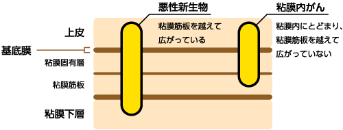 大腸（結腸・直腸）の場合のイメージ図